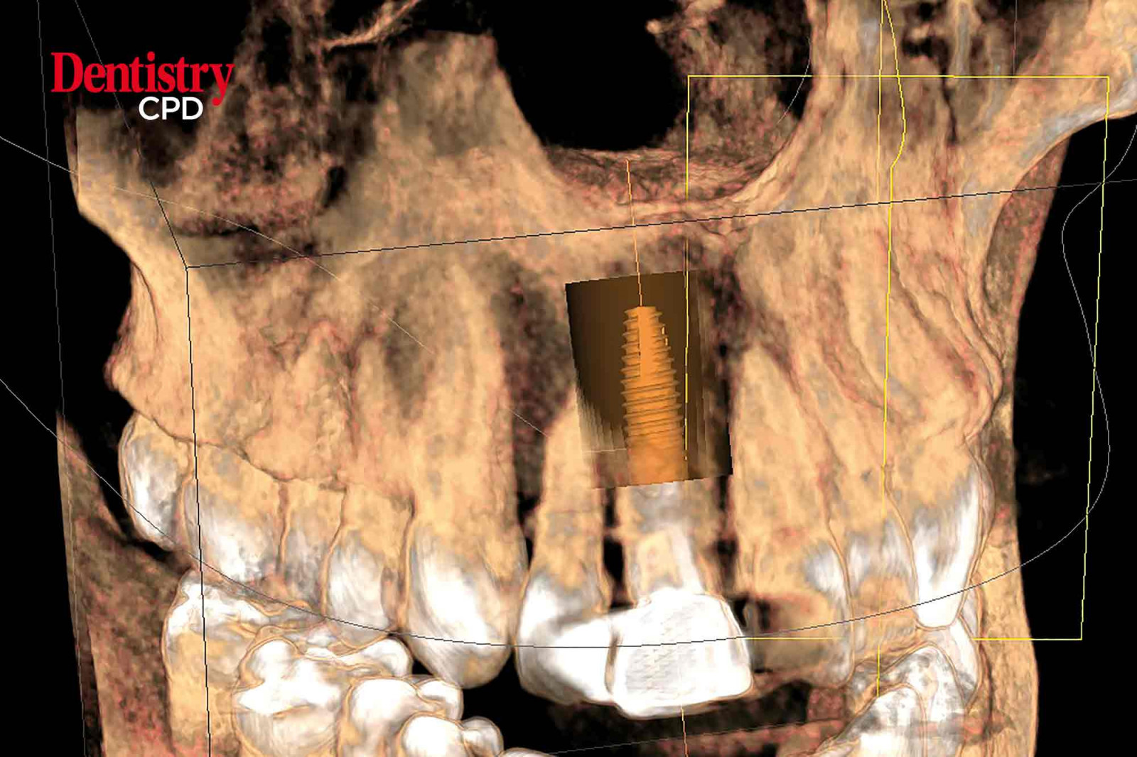 dentistry-cpd-immediate-implant-placement-case-study