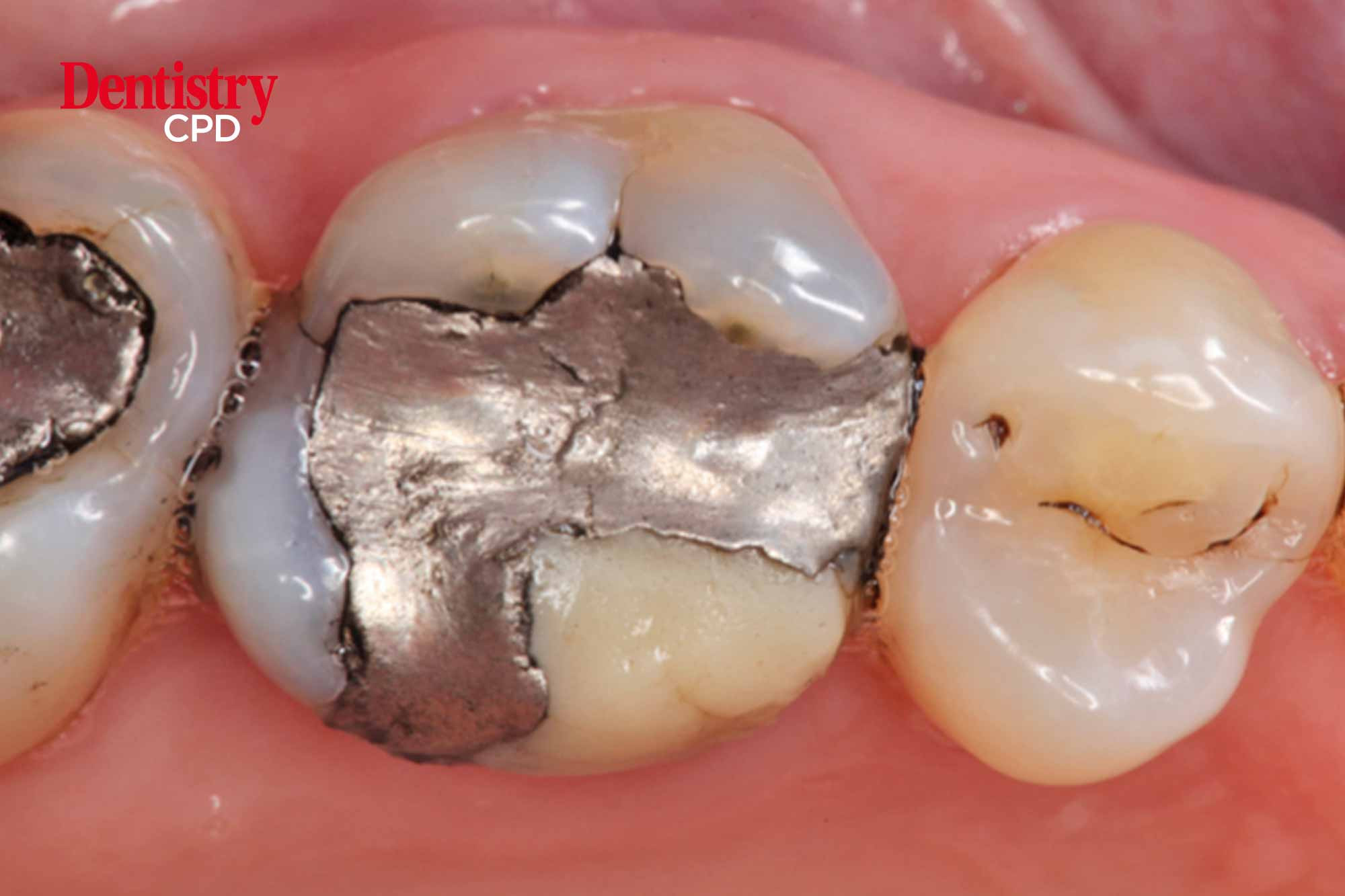 Dentistry CPD Saving a broken first molar