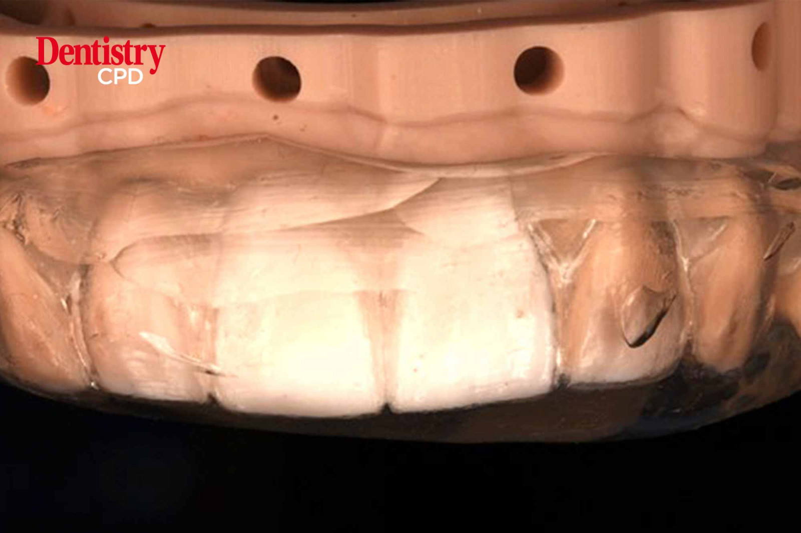Dentistry CPD Injection moulding technique case study