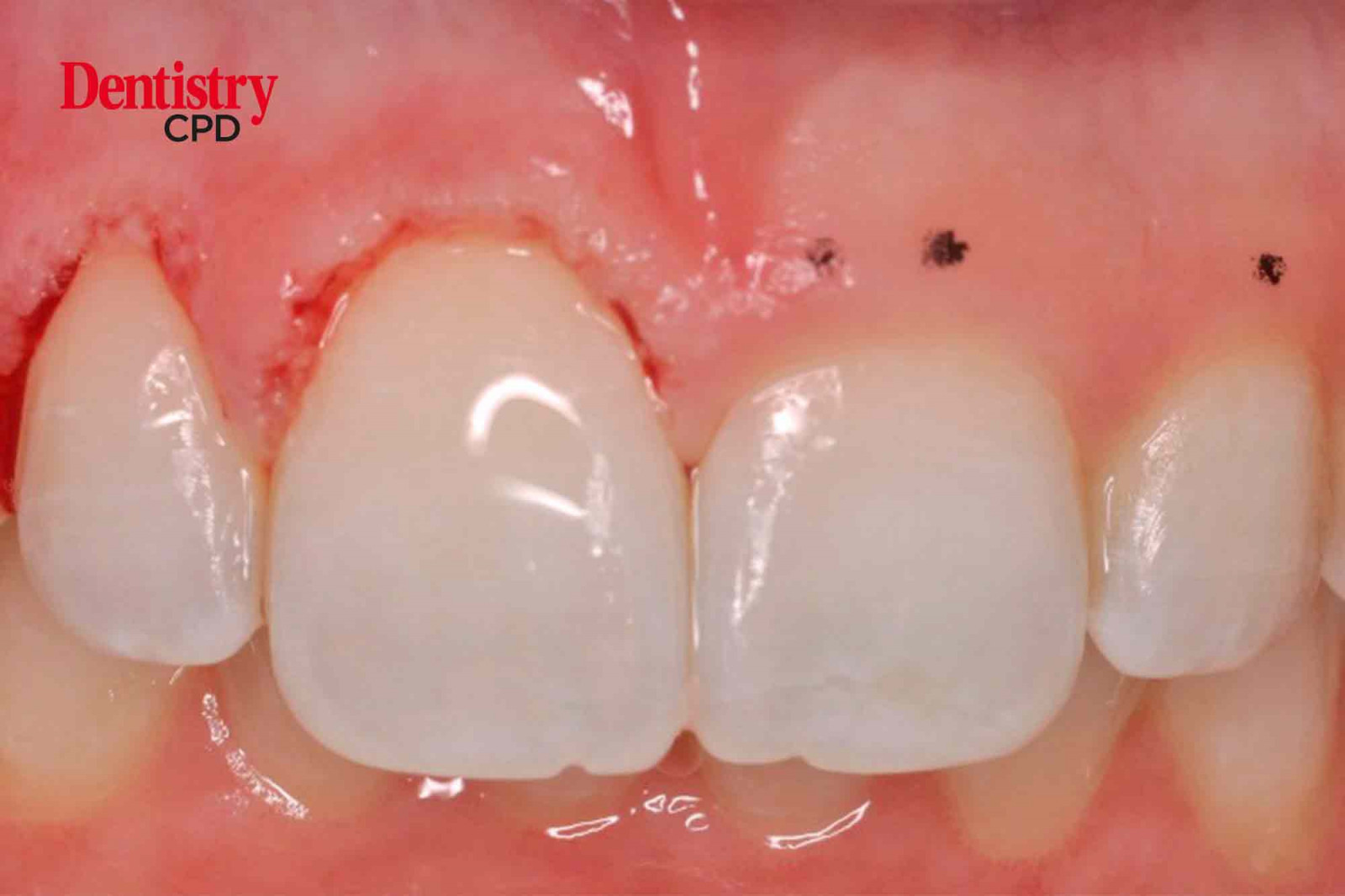 Dentistry CPD - Minimally Invasive Aesthetic Crown Lengthening