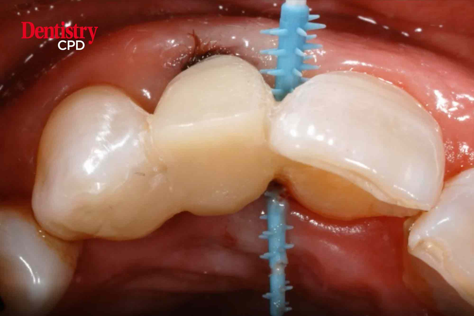 Dentistry CPD Video Resinbonded bridgework A practical guide