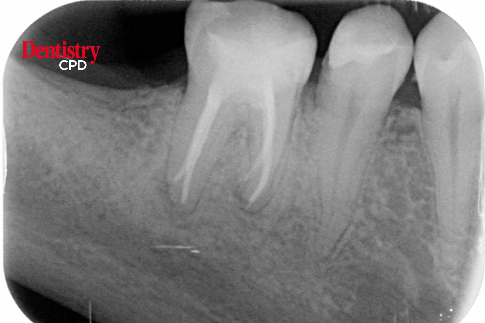 Dentistry CPD Achieving endodontic excellence