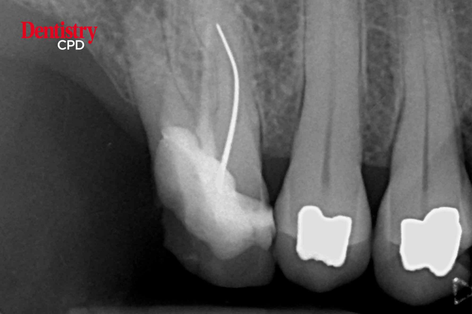 Dentistry CPD Utilising The Anatomy In Molar Root Canal Retreatment