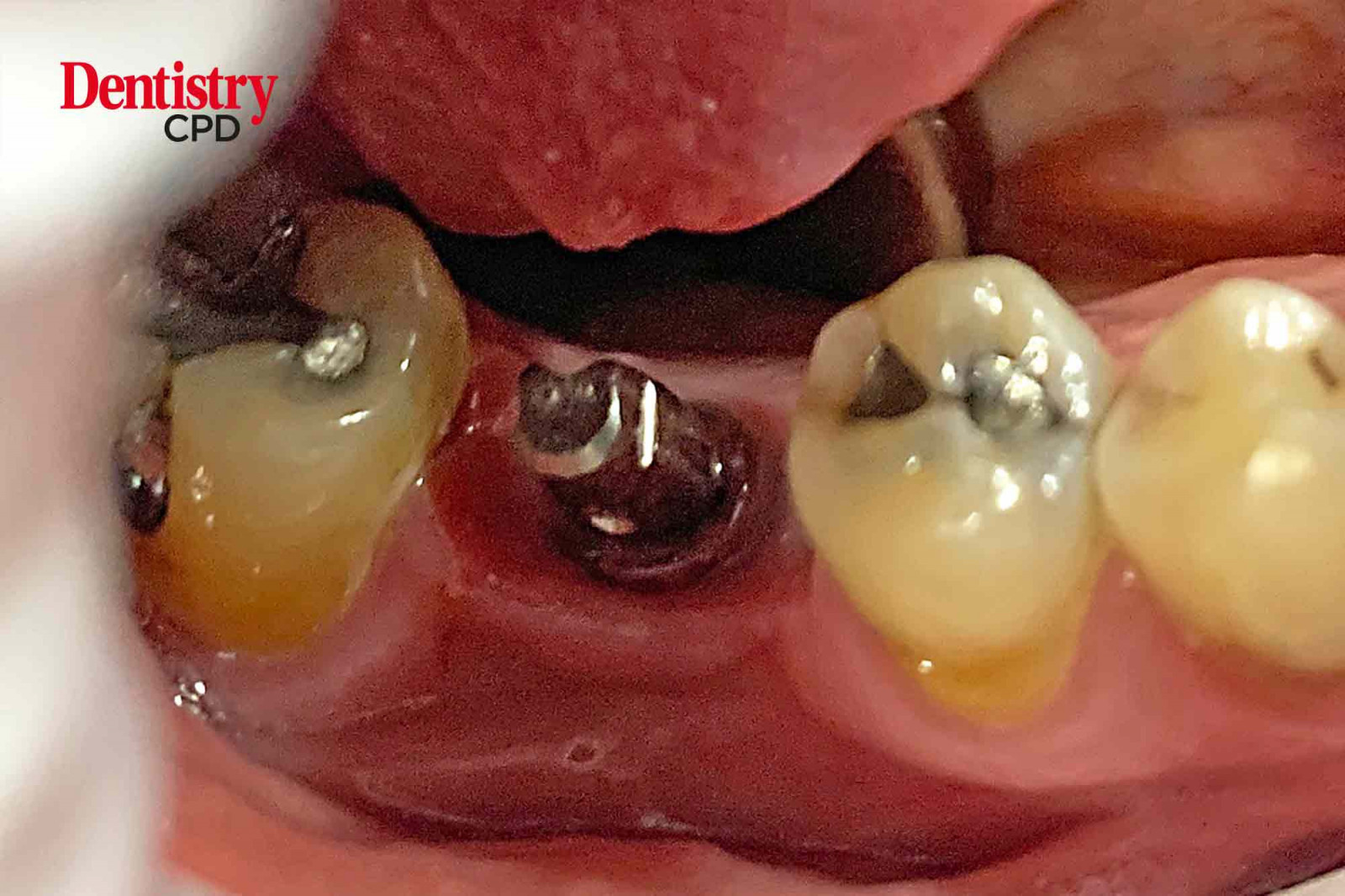 Dentistry CPD - An Improved Peri-implantitis Outlook