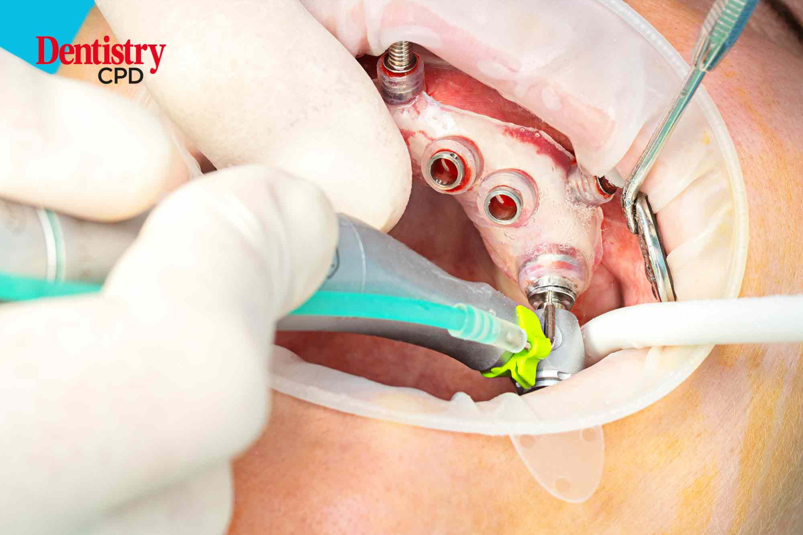 Dentistry CPD Dental nurses Implant dentistry
