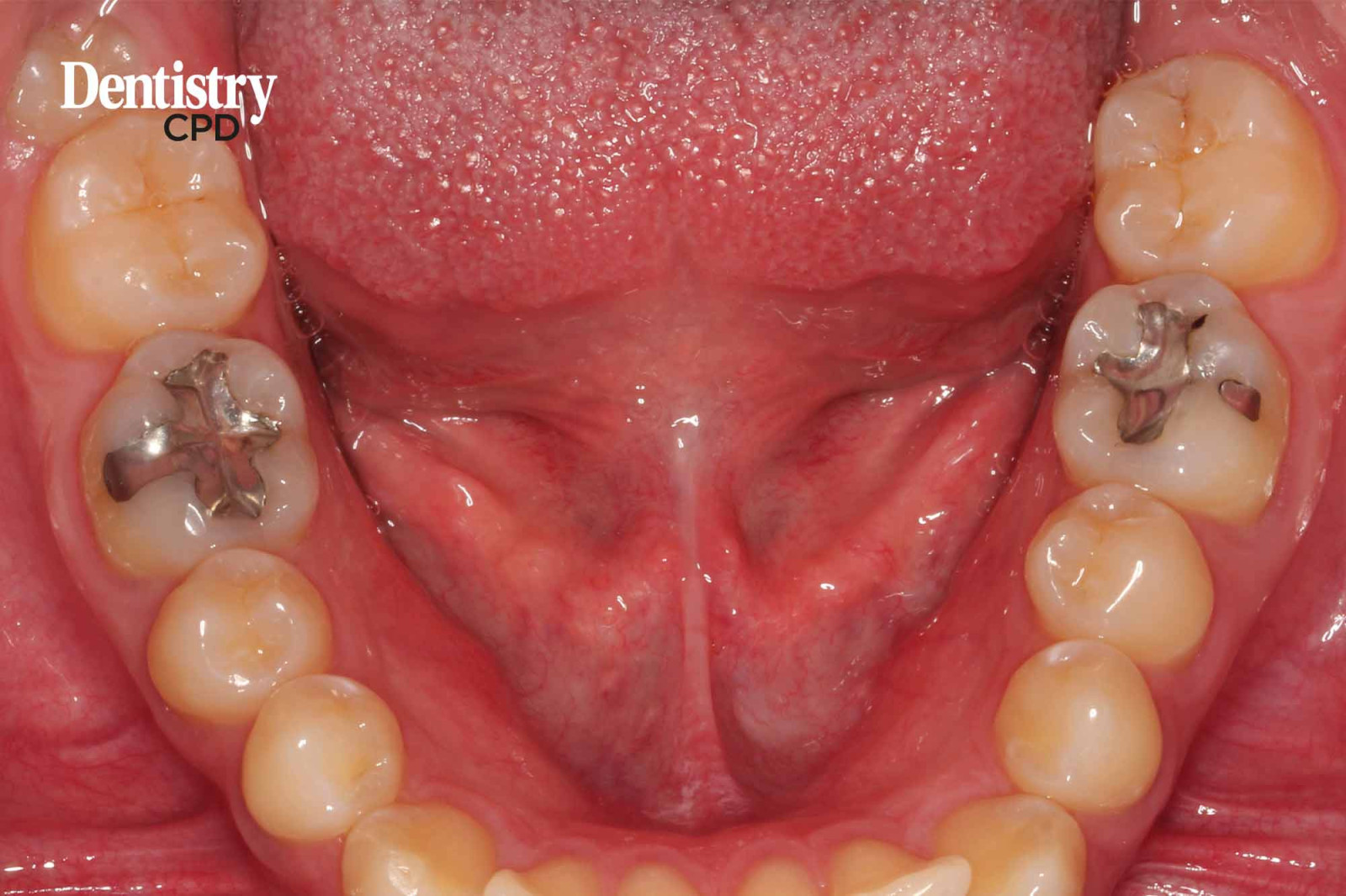 Dentistry CPD CPD Team 2022 Nurse Dental amalgam still with us