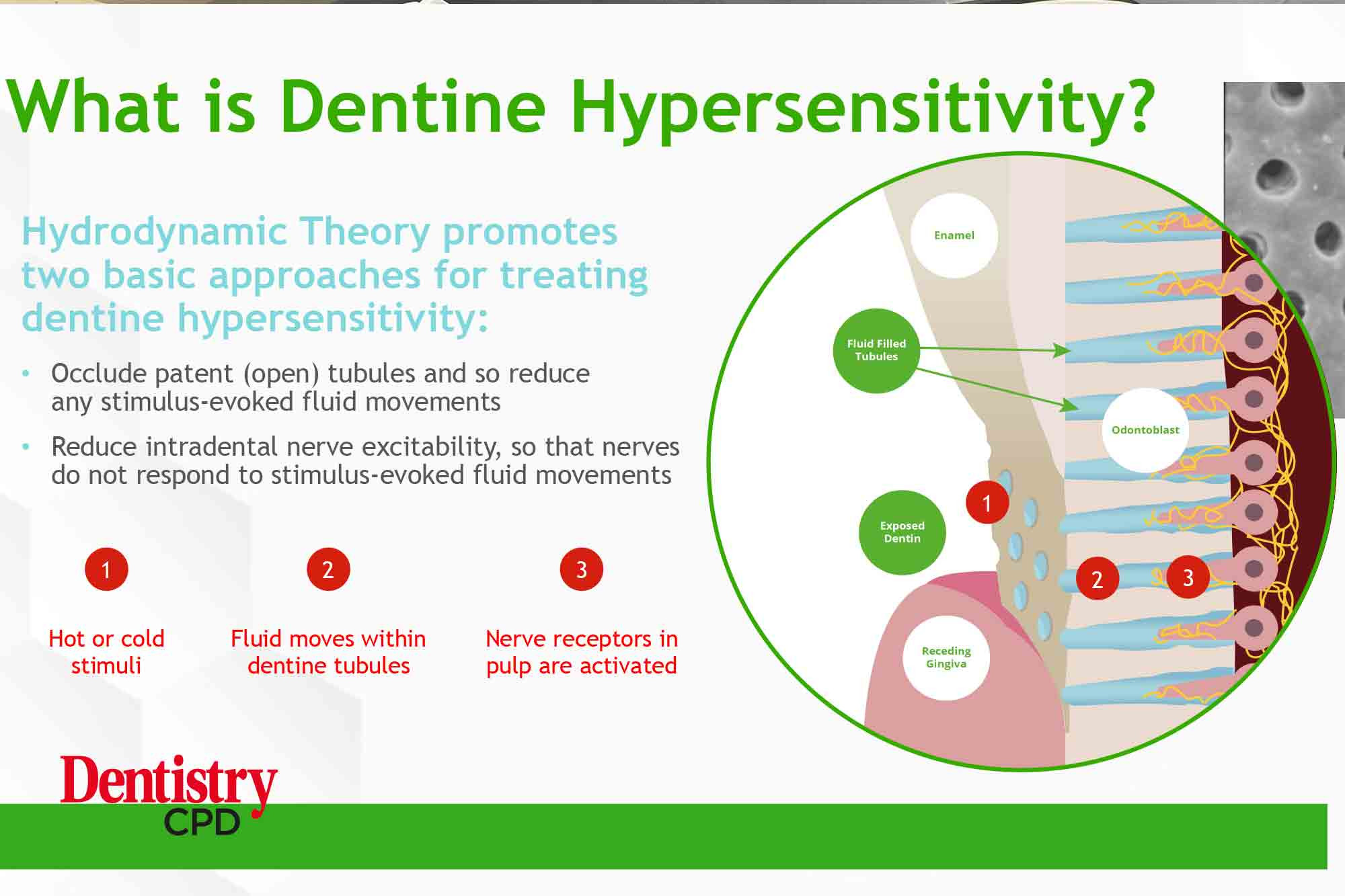 Dentistry CPD Dentine hypersensitivity challenges of diagnosis and