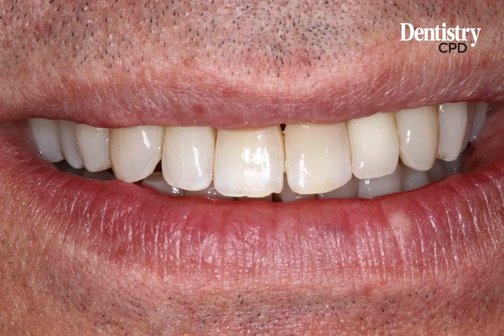 Dentistry CPD A joint restorativeorthodontic approach for missing