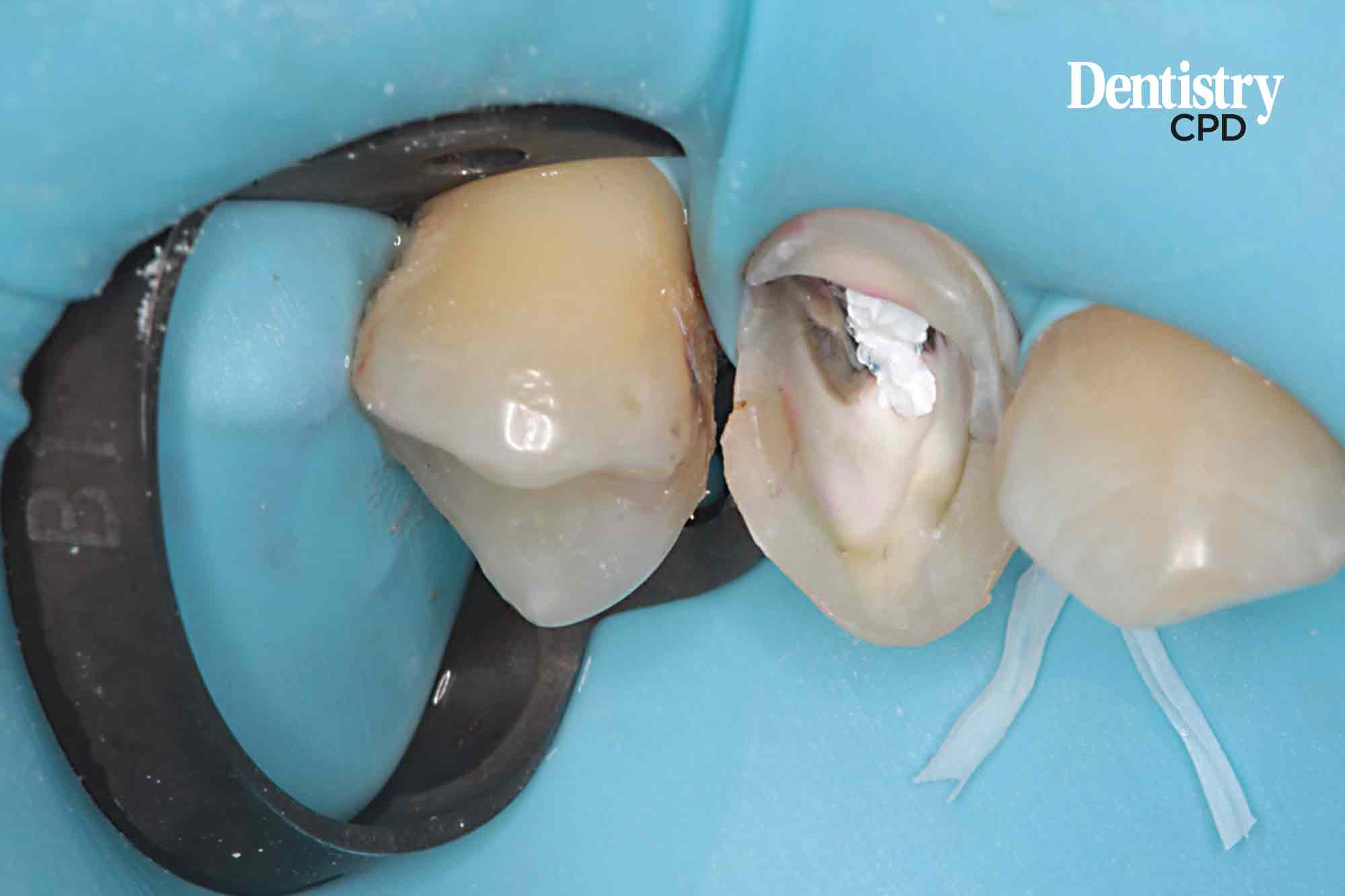 Dentistry CPD In favour of preendodontic buildup