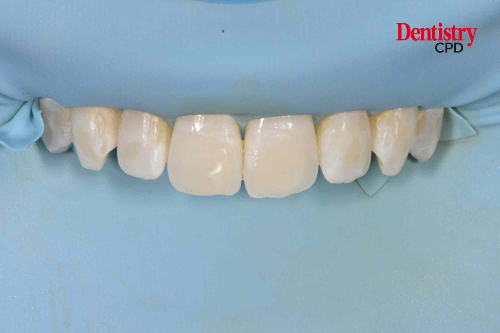 Dentistry CPD Goldstandard isolation with rubber dam