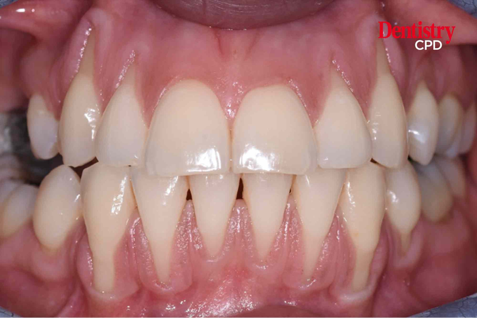 Dentistry CPD - Gingival Recession: Classification