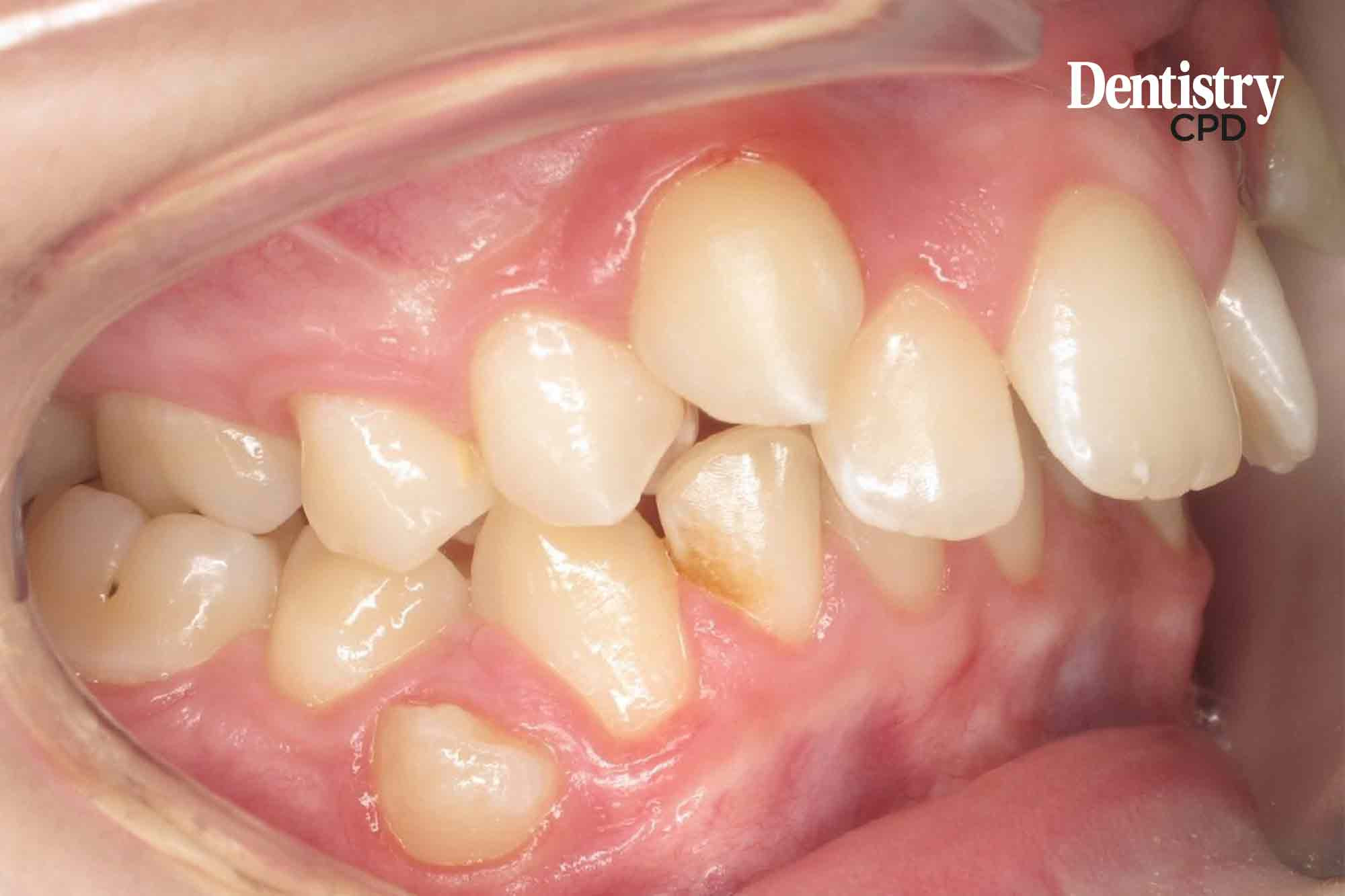 Dentistry CPD The importance of anchorage in orthodontic treatment