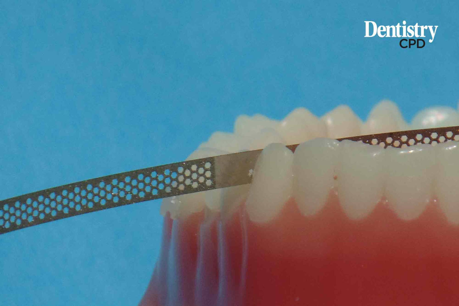 Dentistry CPD Interproximal enamel reduction