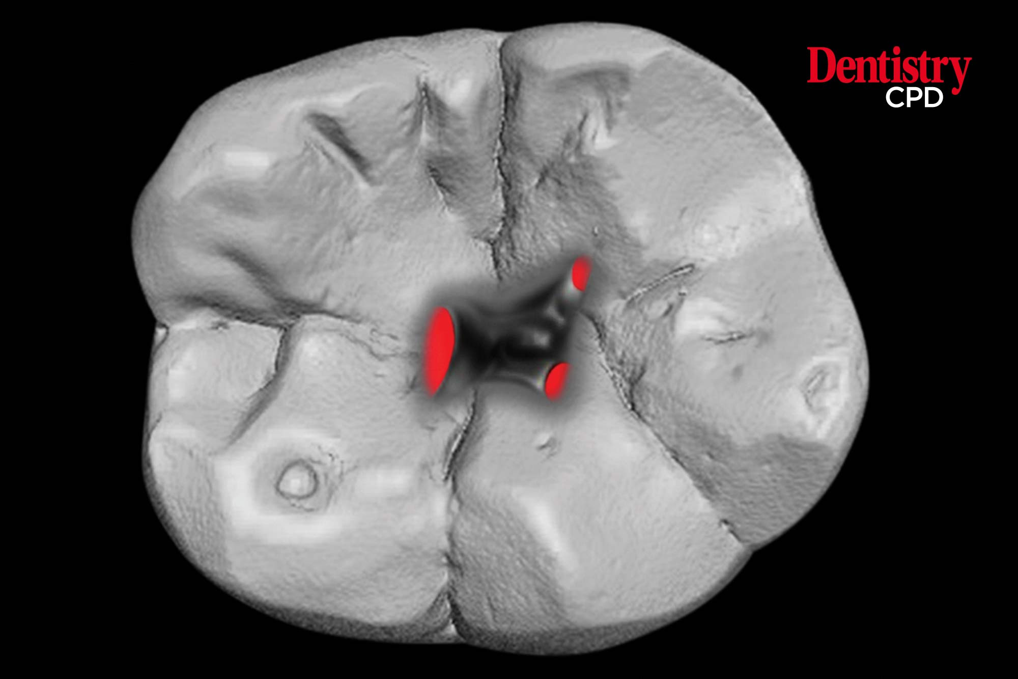 Dentistry CPD Endodontic masterclass access cavity designs