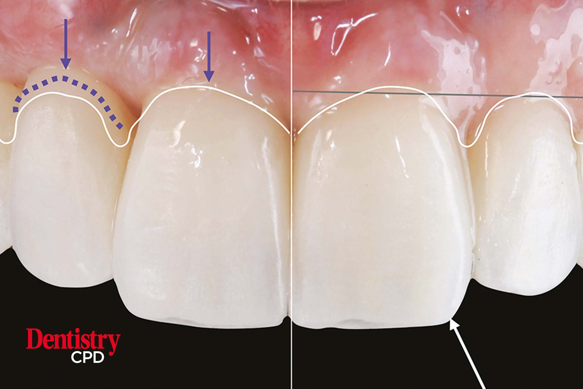 Dentistry CPD - Treatment Of Gingival Recession