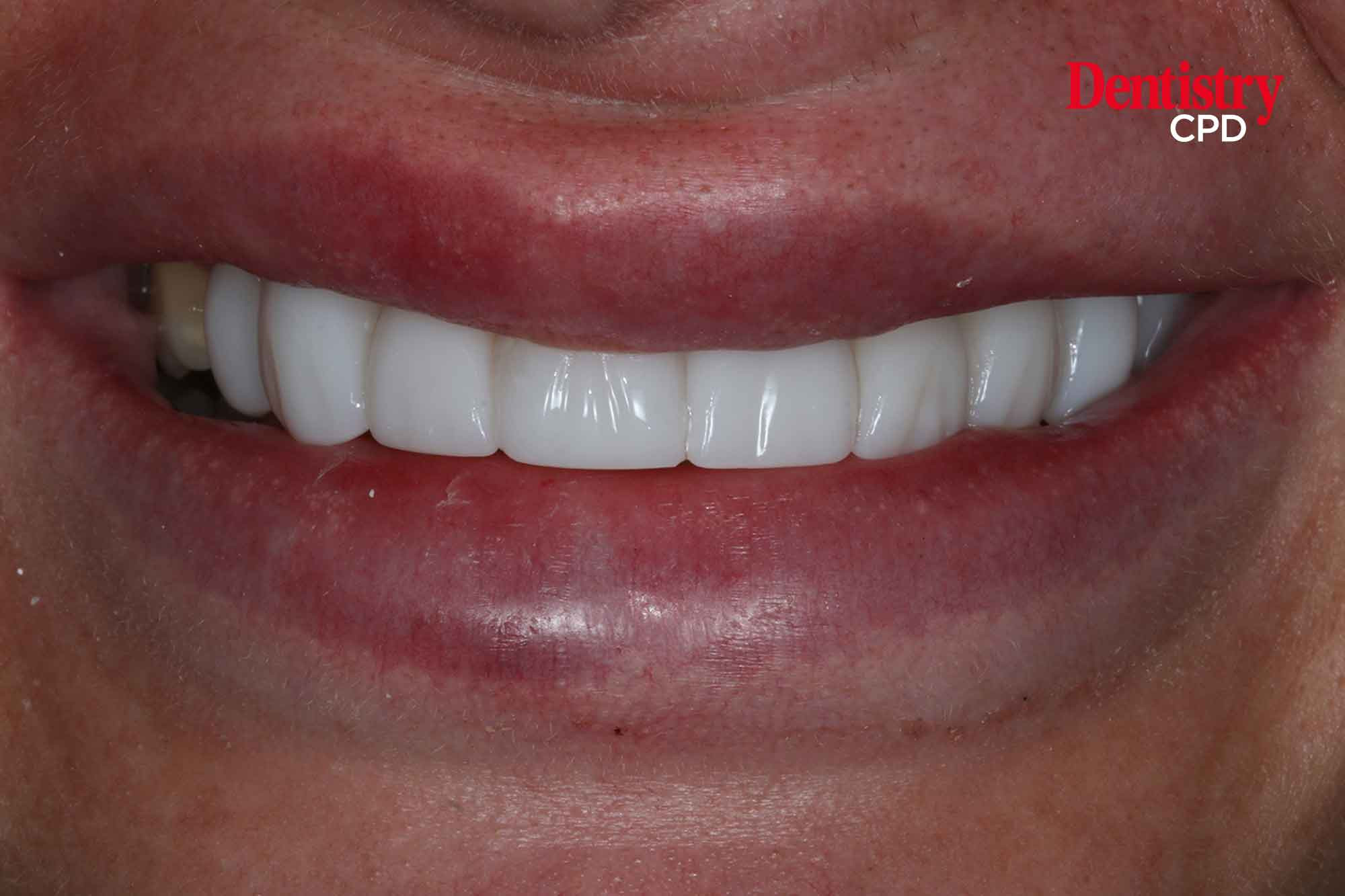 Dentistry CPD CPD Team 2023 Hygienist & Therapist composite smile