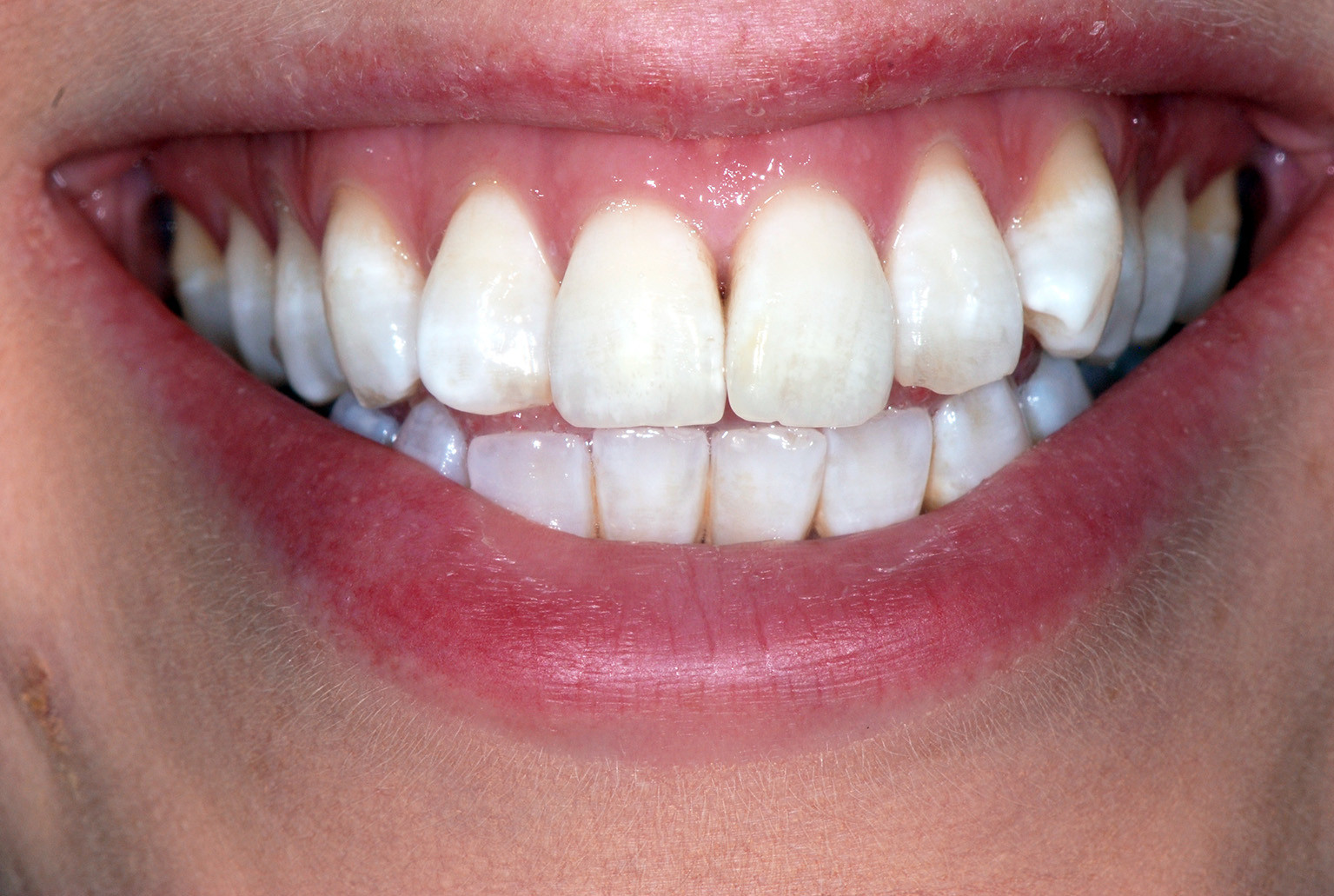 Dentistry CPD Predictable tooth whitening